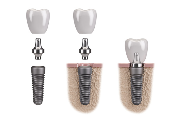 Facts About The Dental Implants Process