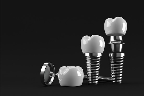 An Implant Dentist Explains the Parts Used in the Procedure from Simply Smiles Dentistry in Tucson, AZ