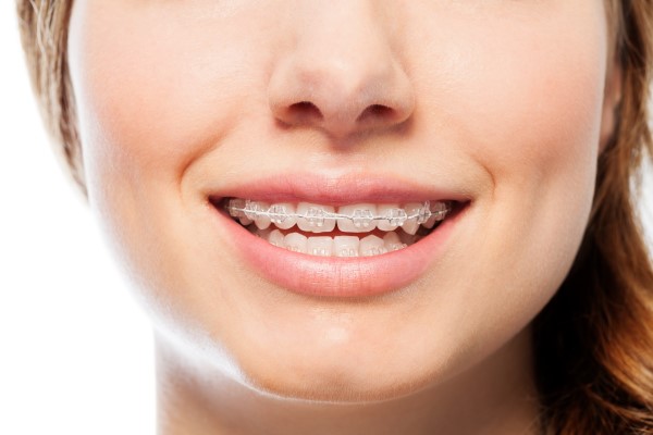 How Cosmetic Braces Differ From Traditional Braces