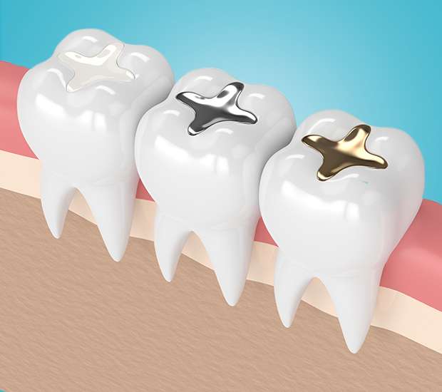 Tucson Tooth Colored Fillings