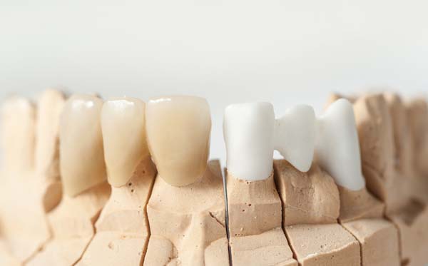 Caring For And Maintaining Your Dental Bridge