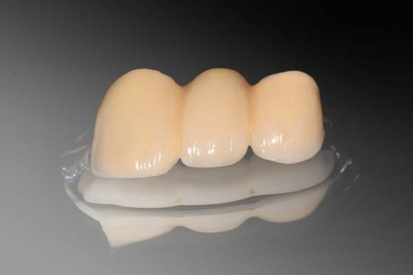 When Is A Dental Bridge Recommended To Replace Missing Teeth?