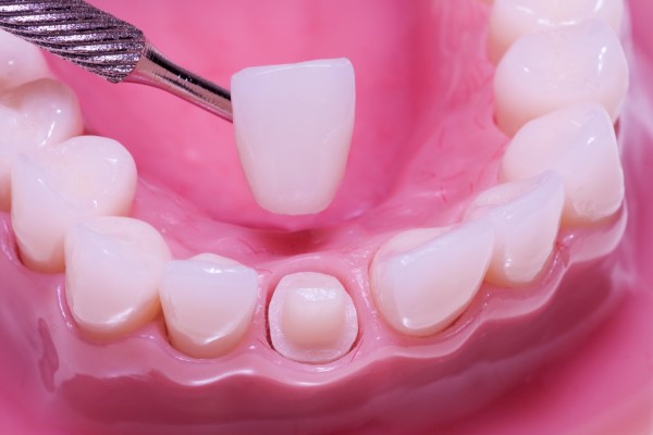 The Steps Of A Dental Crown Restoration