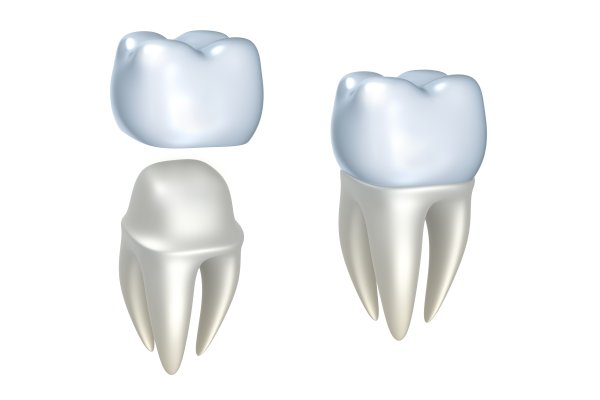 Learn Why Dental Crowns Are Used Instead Of Fillings