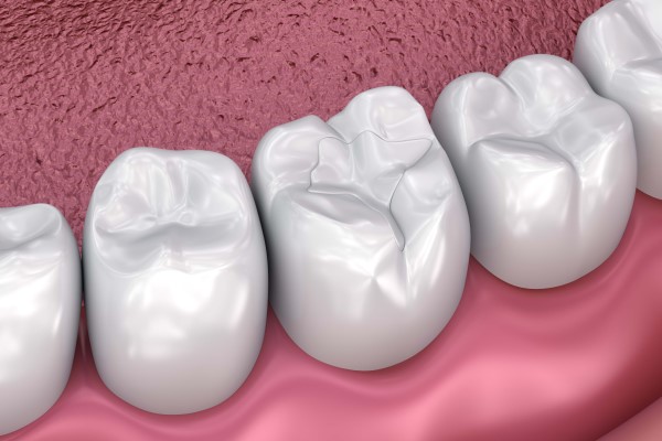 Dental Restoration Options For Decayed Teeth