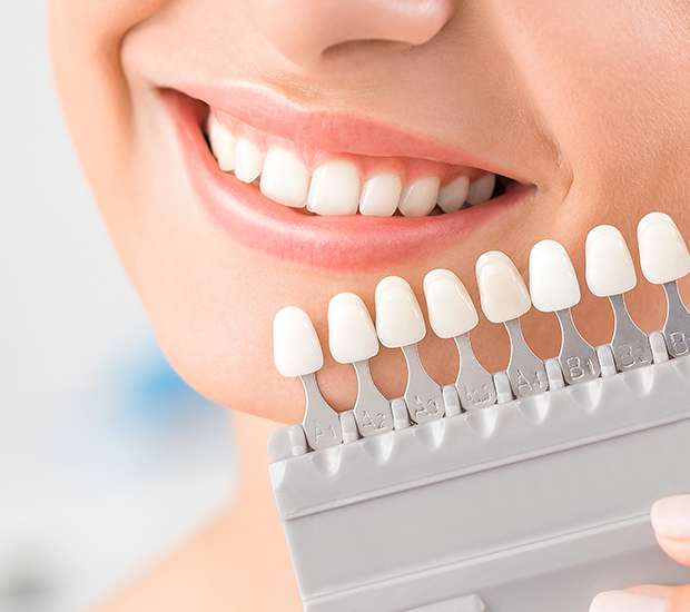Tucson Veneers