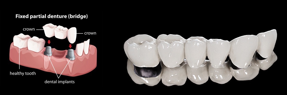 Tucson Dentures