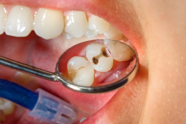 Can A Cavity Become An Emergency?