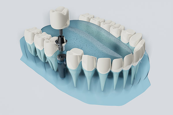FAQs about Dental Implants from Simply Smiles Dentistry in Tucson, AZ