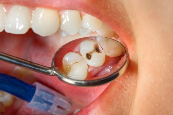 General Dentistry Treatments For A Cavity