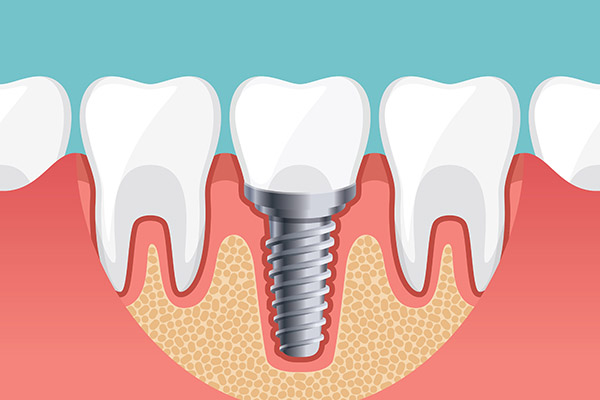 Implant Dentistry Options To Replace a Single Missing Tooth from Simply Smiles Dentistry in Tucson, AZ
