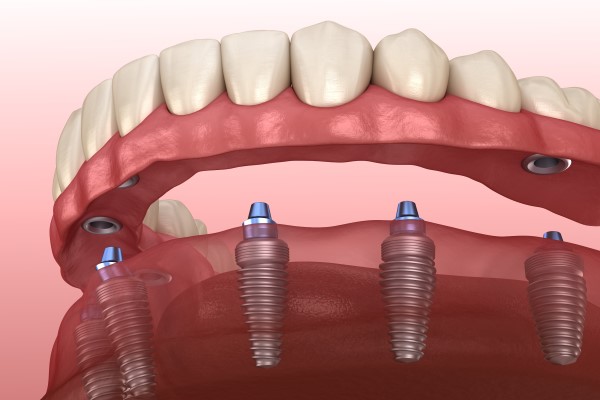 Implant Supported Dentures Tucson, AZ