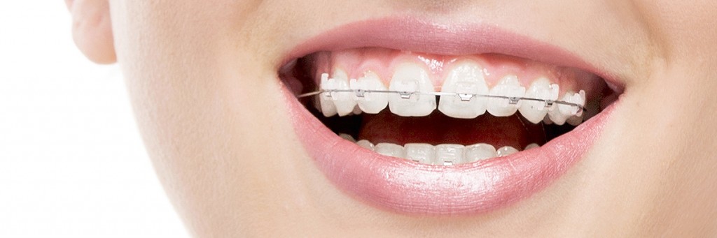 Tucson Types of Braces