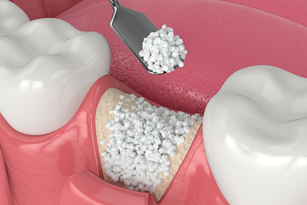 When a Bone Graft Is Needed for an Implant Dentistry Procedure from Simply Smiles Dentistry in Tucson, AZ