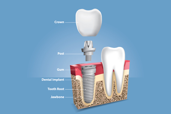 When a Crown Is Placed in the Implant Dentistry Procedure from Simply Smiles Dentistry in Tucson, AZ