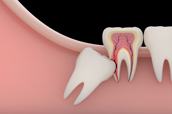 Why Would A Wisdom Tooth Extraction Be Recommended?